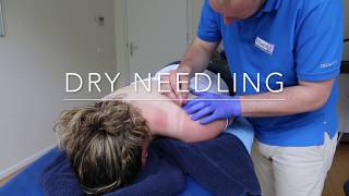 Dry Needling bij Fitaal Fysiotherapie Heerenveen [upl. by Aretha]