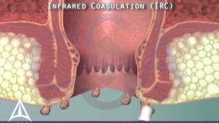 Anal warts amp infrared coagulation treatment  3D animation [upl. by Hecklau]