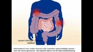 Colitis ulcerosa  Wat zijn de symptomen [upl. by Otrevogir]