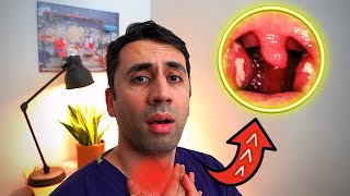 What Causes a Sore Throat HOME Remedies and Cures for Fast TREATMENT Doctor Explains [upl. by Colson]