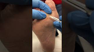 Explore seed corn removal with an Australian Podiatrist Journey into foot care [upl. by Melcher]