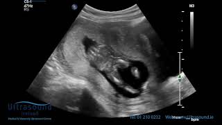 Scan of the Week 15 Weeks Pregnant The Advanced Early Ultrasound [upl. by Hort]