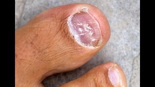 Toenail Fungus Treatment  Home Remedies For Toenail Fungus Know to Work Quickly [upl. by Yatnohs]