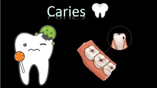 🦷 Caries Dental  Cavidad oral  Cabeza y Cuello  Patología [upl. by Nylassej831]