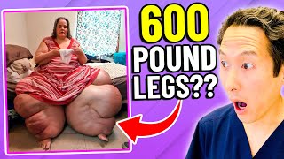 Plastic Surgeon Reacts to MY 600 Lb LIFE How to Lose 600 Lb Legs [upl. by Nevile]