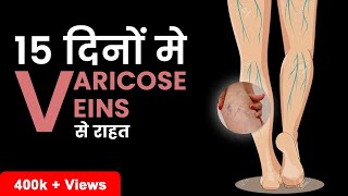 What are Varicose Veins  Get rid of Varicose Veins in Just 15 Days  Fitnesswithgomzi [upl. by Eneri]