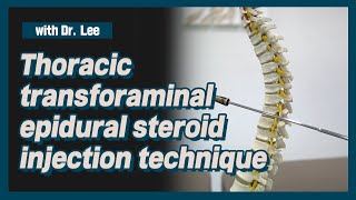 TThoracic transforaminal epidural steroid injection technique [upl. by Radcliffe]