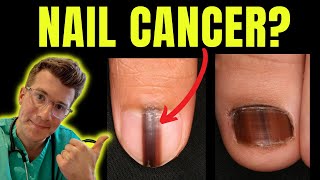 Cancer of the nail Doctor ODonovan explains Acral Lentiginous Melanoma and Subungual Melanoma [upl. by Kcaj]