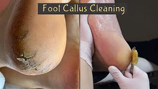 Callus Removal From Feet 👣 Foot Callus Removal Satisfying [upl. by Robinette797]