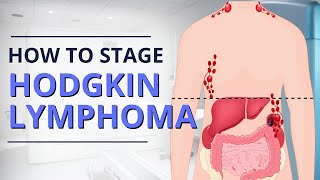 Hodgkin Lymphoma Staging From Diagnosis to Prognosis  The Patient Story [upl. by Dermott759]