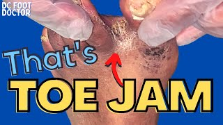 Thats Toe Jam The Buildup Between Toes Explained Trimming Of Fungal Toenails and Skin Scales [upl. by Hazem]