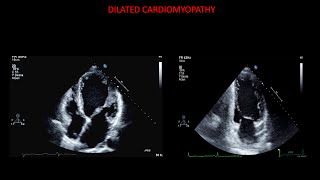 Echocardiography in dilated cardiomyopathy [upl. by Junno]