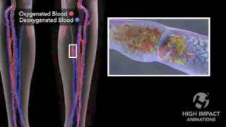 Deep Vein Thrombosis [upl. by Evod754]