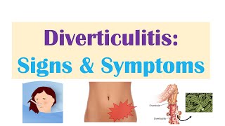 Diverticulitis Signs amp Symptoms And Why They Occur [upl. by Eneryt]