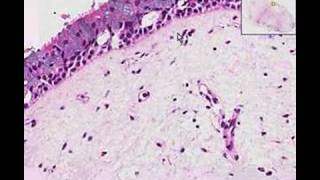 Histopathology Nose Nasal polyp [upl. by Ahsita]