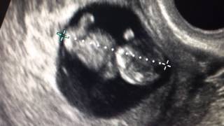 9 weeks ultrasound baby moves 219 [upl. by Thadeus237]