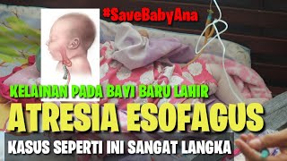 ATRESIA ESOFAGUS Kelainan Pada Bayi Baru Lahir Yang Kasus Seperti Ini Sangat Langka Di Dunia [upl. by Oirramed]