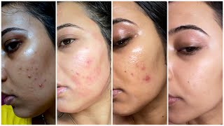 My Detailed 7 Days Nighttime Skincare Routine to remove Pimples Acnes Pimple Marks Dark Spots [upl. by Namreg]