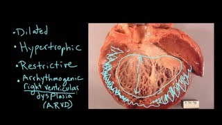 What is Cardiomyopathy [upl. by Yornek]