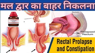 बावासीरमल द्वार का बाहर निकलनाहोमियोपैथिक दवा बावासीर कीPilesRectum prolapseConstipation [upl. by Hare]