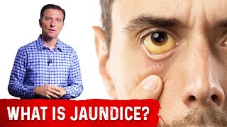 Jaundice Symptoms Explained by DrBerg In Very Simple Terms [upl. by Garris]