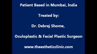 Blepharospasm amp Hemifacial Spasm Eye Twitching Treated with Botox Injection [upl. by Marla]