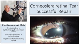 Corneoscleralretinal tear How to achieve successful outcome [upl. by Moynahan]