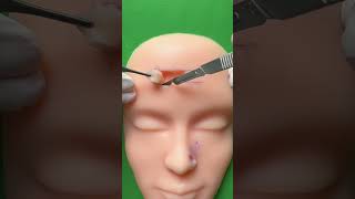 Bilateral advancement flap for forehead reconstruction flap incision part 3 Link in bio for pad [upl. by Dorraj]