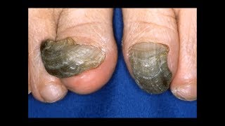 How to Get Rid of Black Toenail Fungus in Half the Time [upl. by Ujawernalo]