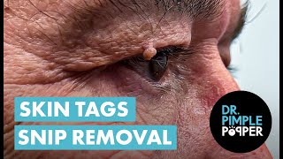 Acrochordon Snip Removal Dr Pimple Popper REMOVES Skin Tags Near Eyes [upl. by Aiela896]