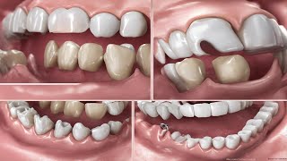 Dental Bridge The Perfect Solution for Missing Teeth  Is This Procedure Right for You [upl. by Kaylee]