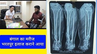 Treatment of Bone Infection Nonunion tibiafracturetreatment fracture ilizarov [upl. by Goodrich324]