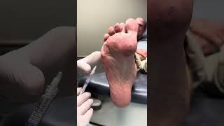 Radiesse dermal filler injections for pain on the ball of the foot [upl. by Vasilis161]