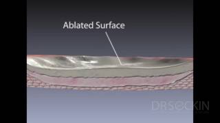 Proper Removal of Endometriosis Lesions [upl. by Thad]