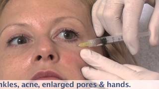 Dermaheal SR to correct fine lines around eyes [upl. by Ellenuahs]