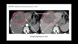 3 LIRADS Overview of CTMR algorithm and major features  Part 1 By Dr Victoria Chernyak [upl. by Clorinde587]