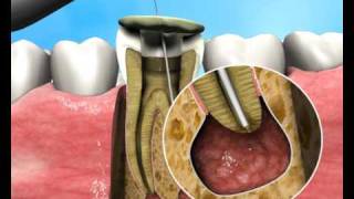 Treatment of Apical Periodontitis  a new approach [upl. by Moria]