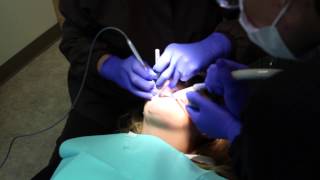 Peoria Dentist  Filling a cavity using Air Abrasion [upl. by Siulesoj]