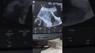 Two different cases of Endometrial Hyperplasia diagnostic ultrasound cases [upl. by Dud]