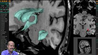 Understanding the Lateral Ventricles in Neuroanatomy  Brain Structures Explained [upl. by Ariat]