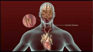 Stroke  Carotid Artery Disease and TIA [upl. by Laeno]