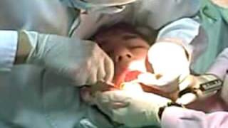 Dentistry Horrors Wisdom tooth procedure full [upl. by Kendall]