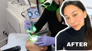 ⚡️REMOVING MY FRECKLES WITH PICOWAY LASER ⚡️WHAT YOU NEED TO KNOW 👀 [upl. by Ynitsed908]