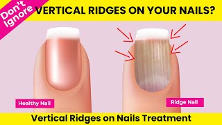 Don’t Ignore if Vertical Ridges on Your Nails English  Vertical Ridges on Nails [upl. by Renat591]