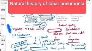 Natural history of lobar pneumonia Respiratory 50  First Aid USMLE Step 1 in UrduHindi [upl. by Annairba]