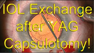 IOL exchange surgery with open capsule after YAG capsulotomy  Dr Simon Chen [upl. by Narbig]