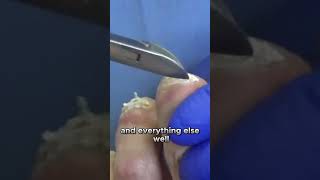 Uncertainties of Fungal ToeNail Treatment fungaltoenail drnailnipper [upl. by Norehs]