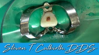 Endo and Internal Bleaching  Dental Minute with Steven T Cutbirth DDS [upl. by Ayitahs]