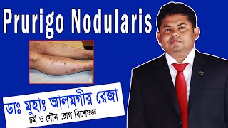 Prurigo Nodularis চিকিৎসা ও সঠিক ব্যবস্থাপনা  ডা আলমগীর রেজা  প্রুরিগো নোডুলারিস চিকিত্সা [upl. by Phillipp646]