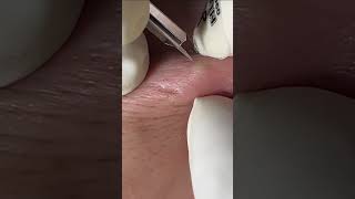 Acne Treatment Huong Da Nang 177  membershort [upl. by Yaluz]